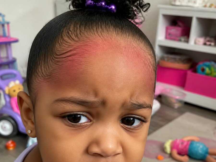 child-hairstyle-too-tight-redness-around-the-hairline