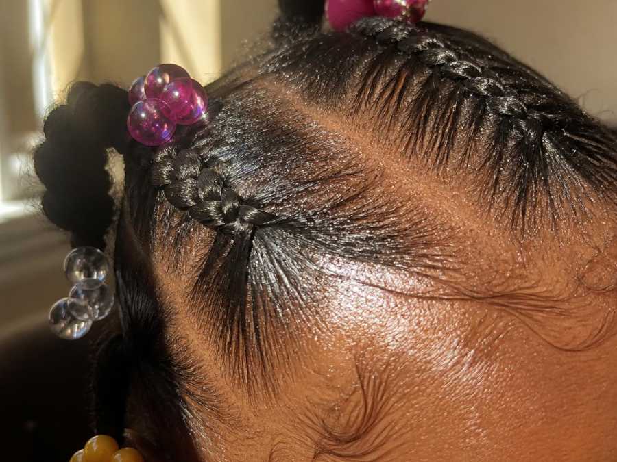 child-hairstyle-too-tight-shiny-or-stretched-scalp