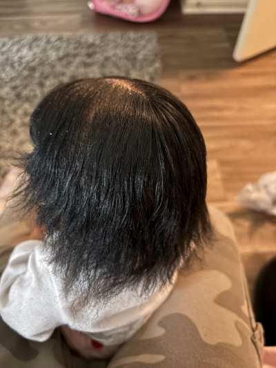 child-hair-moisture-and-the-hairline